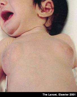 Neonatal Medicine Neonatal Gynaecomastia